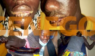 Senegal: Rare Disease Breaks Out Among Dozens Of Fishermen Causing Panic